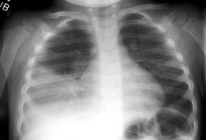 Pneumonia (2 CEU's) course image